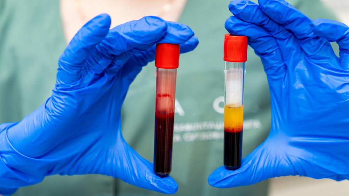 ce-inseamna-daca-ai-transaminazele-crescute--prof--dr--roxana-sirli-costa-30-40-lei--e-cea-mai-severa-forma--evolueaza-la-fibroza-si-ciroza-in-mai-putin-de-10-ani_32479100