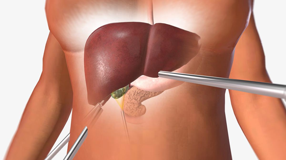steagul-rosu-al-cirozei-hepatice_96325800