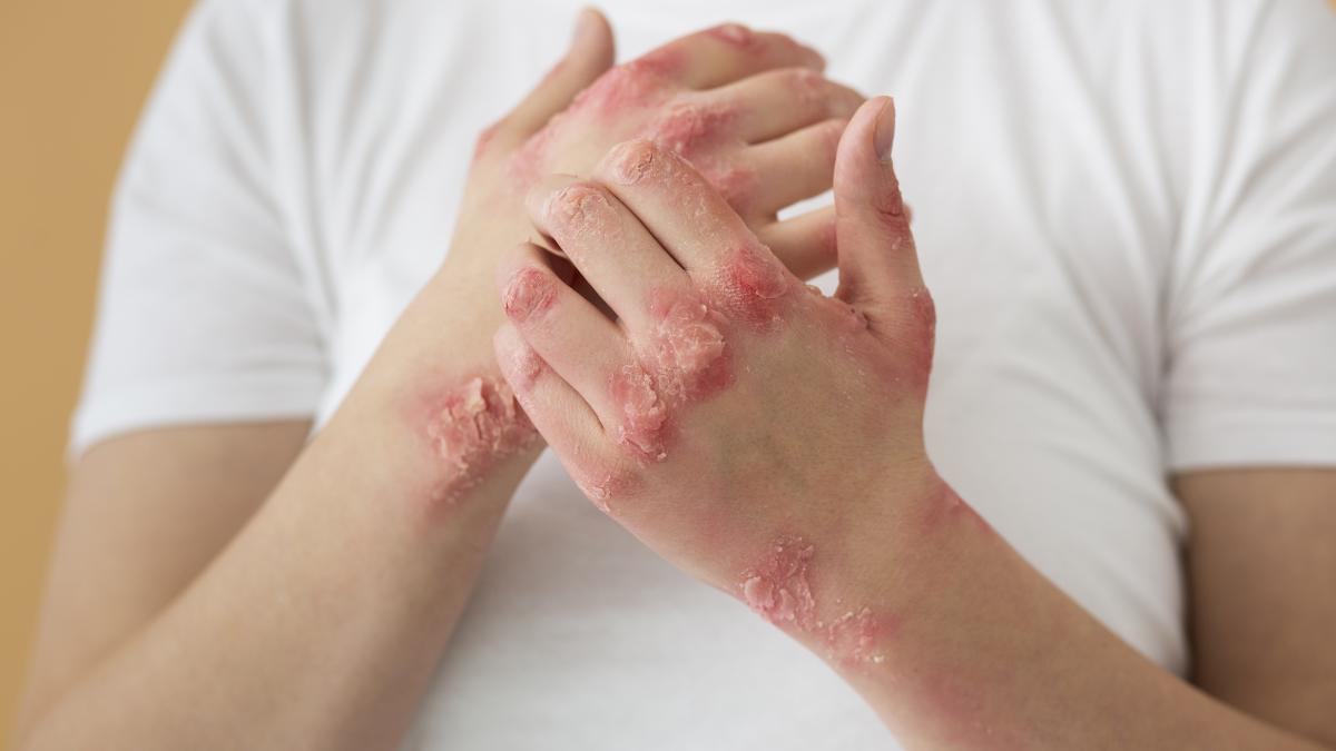 dermatita-seboreica_64344200