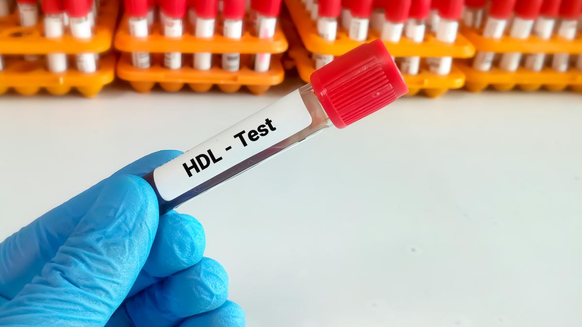 colesterol-hdl-scazut_63959800