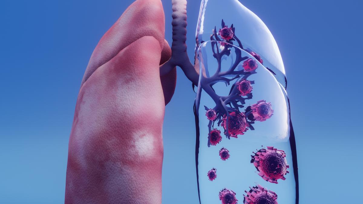 cancer-plamani_52584600