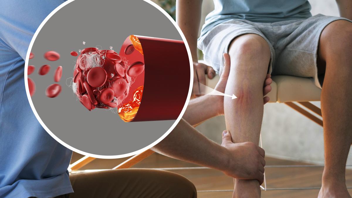 tromboza-venoasa-profunda--diagnostic-_20312300