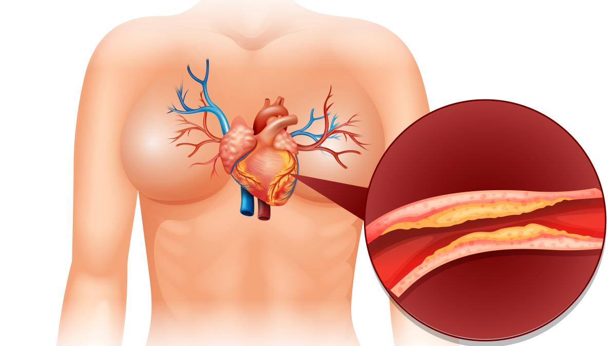 preinfarct_41060600