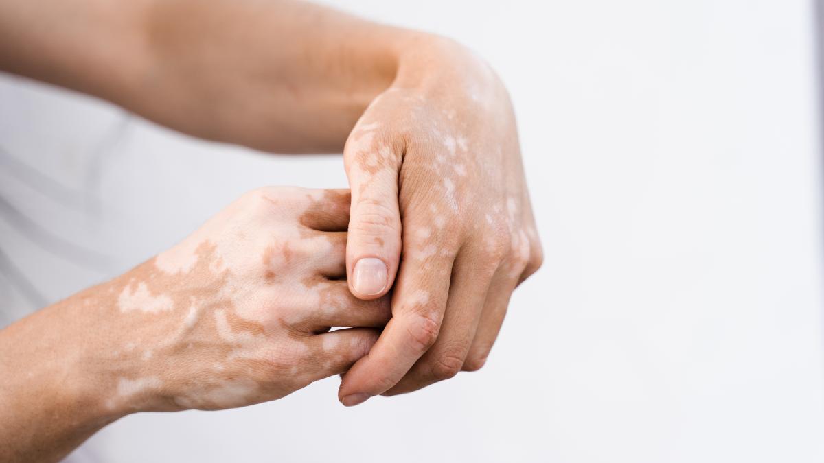 vitiligo1_06220400