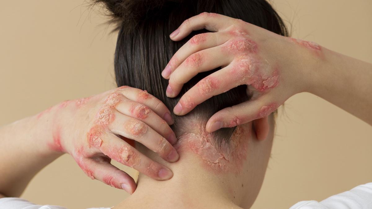 psoriazis_86580900