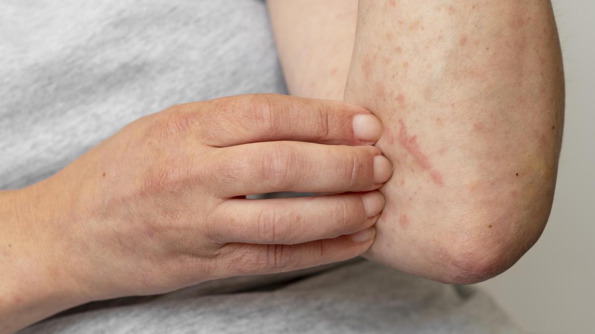 dermatita-atopica_87770700