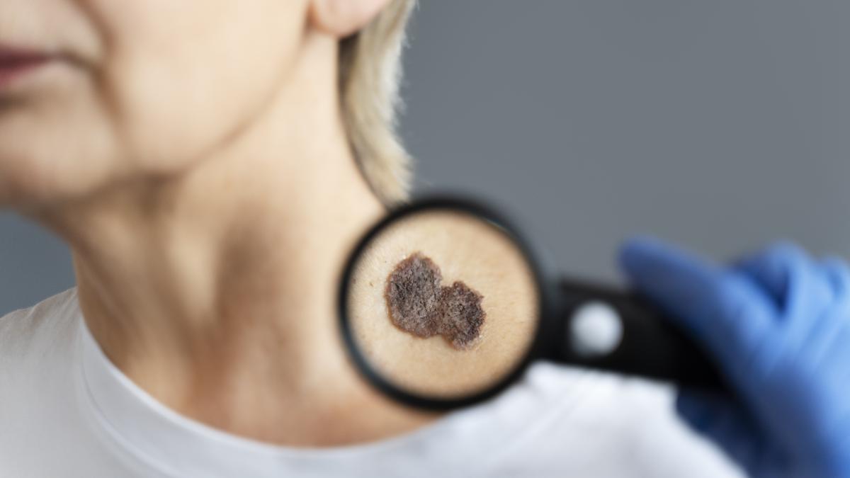 vaccinul-pentru-cancerul-de-piele--in-teste-_14014400