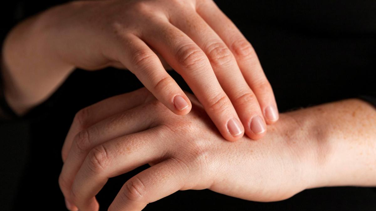 urticaria--factor-de-risc-pentru-cancer-_52323700