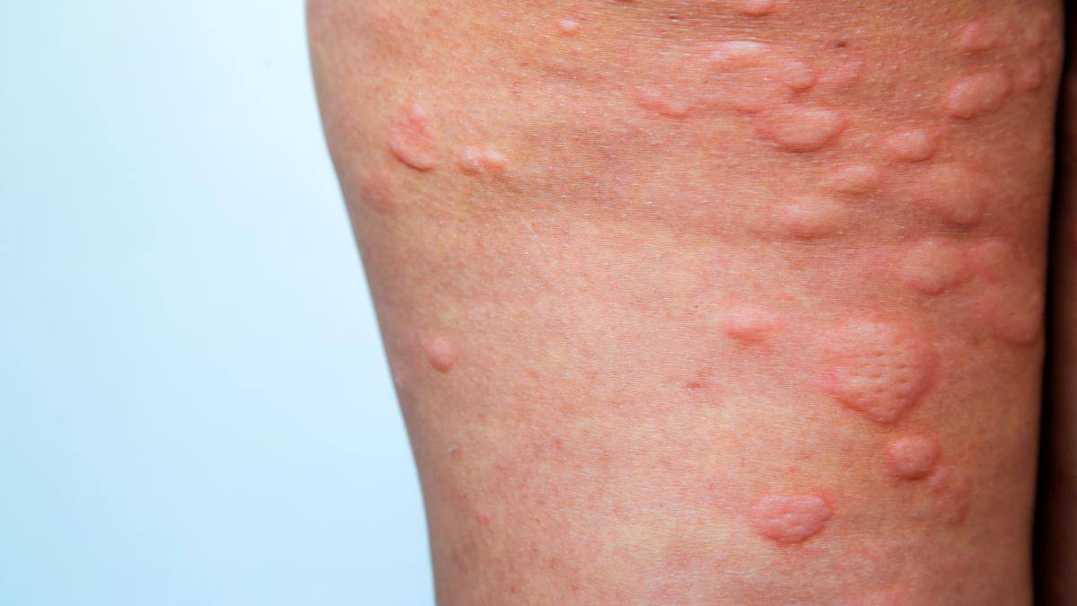 psoriazis_86668300
