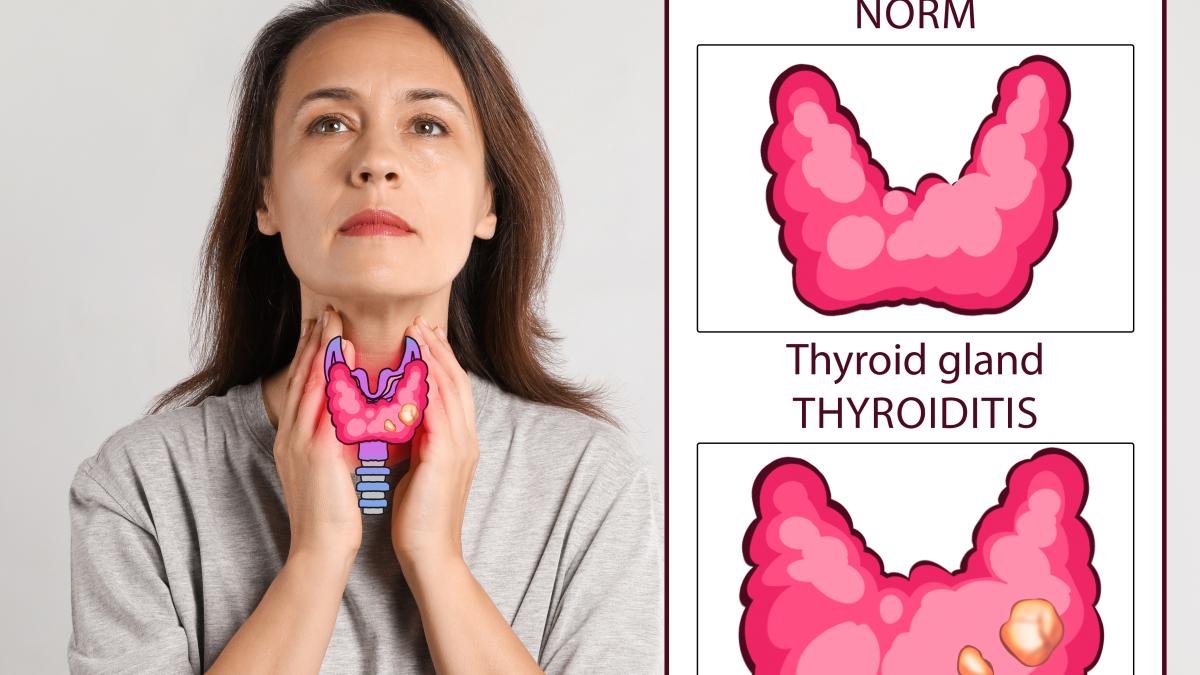 noduli-tiroida_64857600