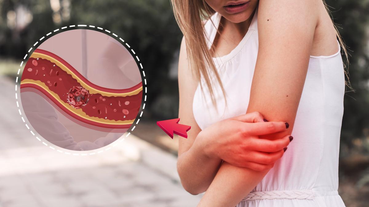 cancer-piele-melanom_55152200