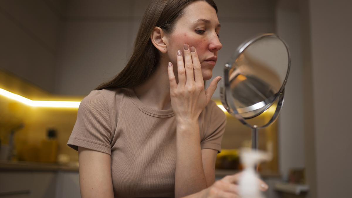 rosacea1_28584400