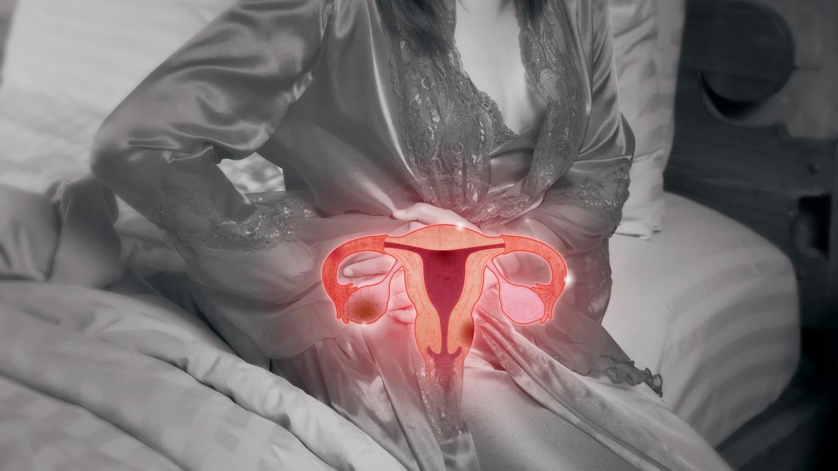 chist-ovarian_41928500