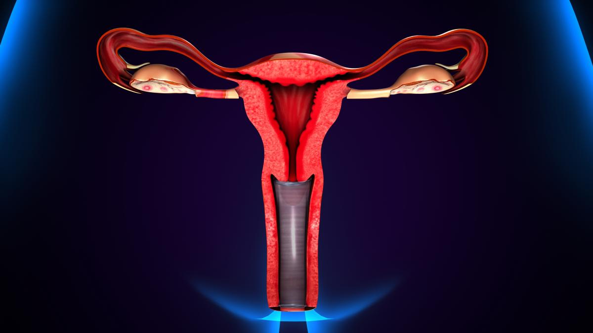 fibrom-uterin_28989400