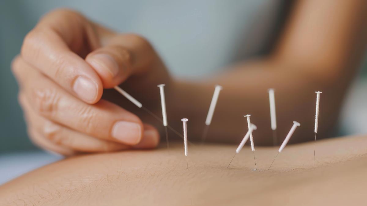 acupunctura1_82067600