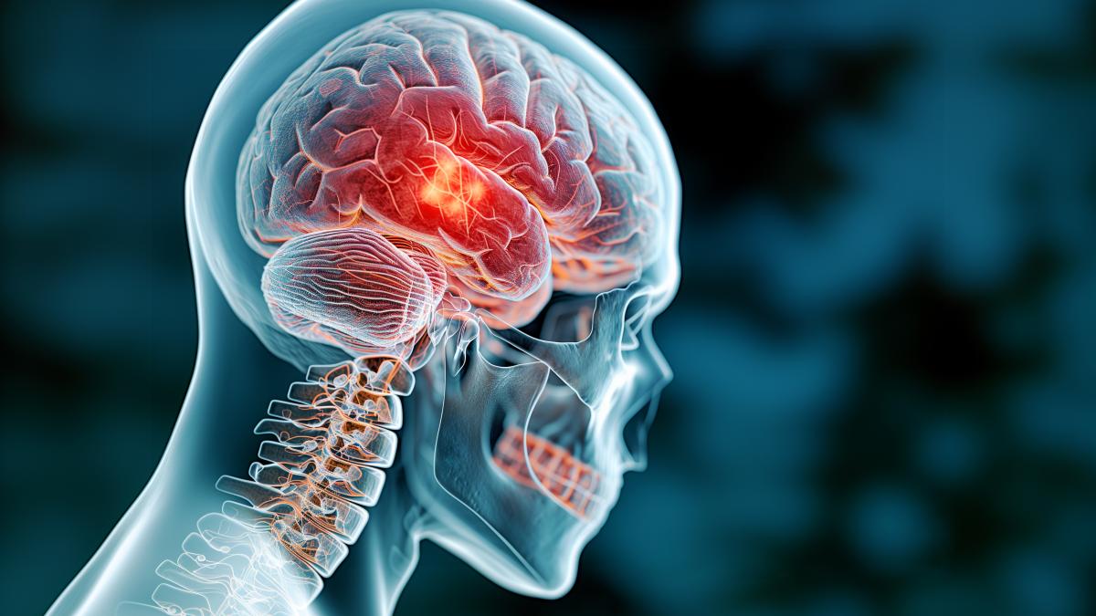 romanii-cu-avc-ischemic--expusi-agravarii-rapide-a-tulburarilor-cognitive-_22956600
