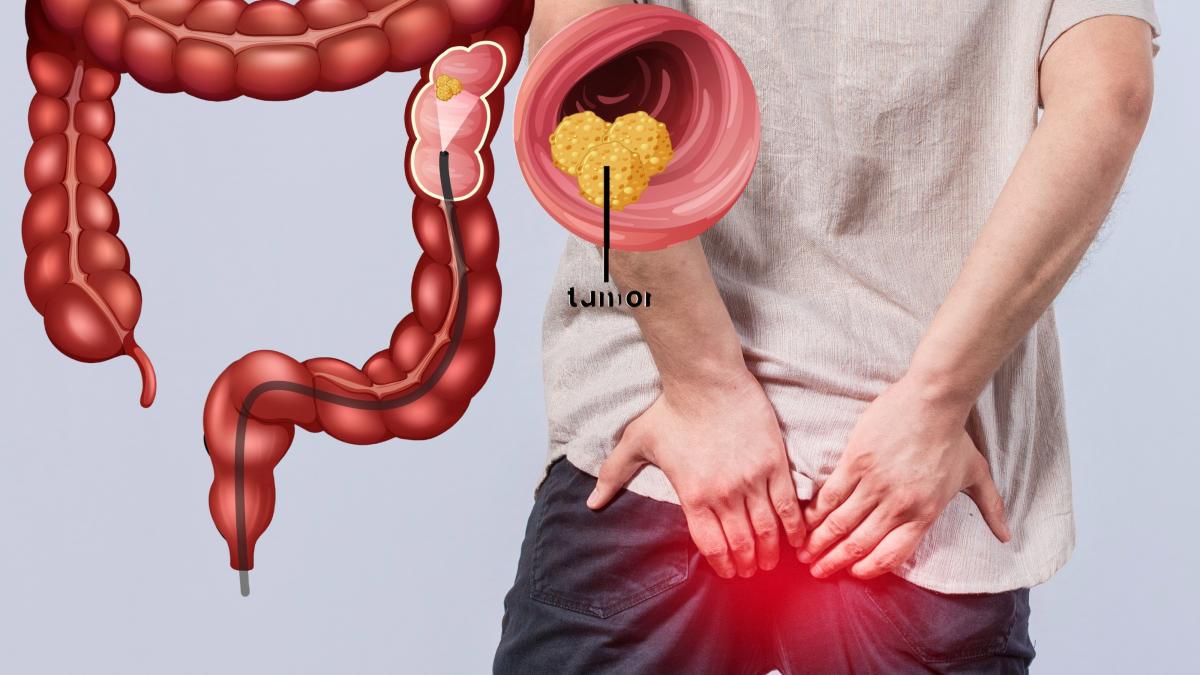 hemoroizi-cancer-colon_44021700