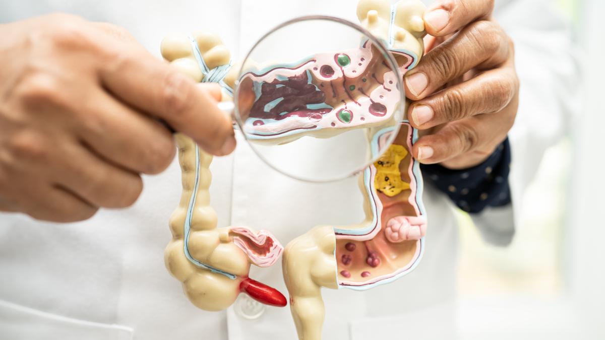 cancer-colorectal_83262900