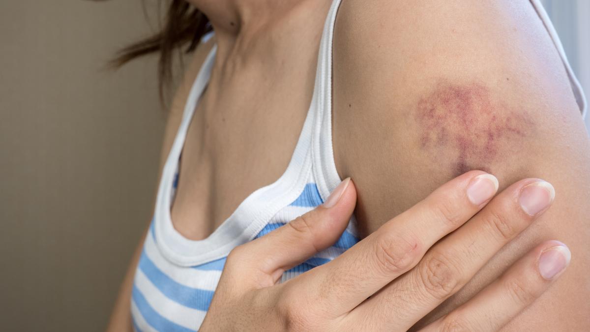 vene-sparte-vanatai-medical_57914800
