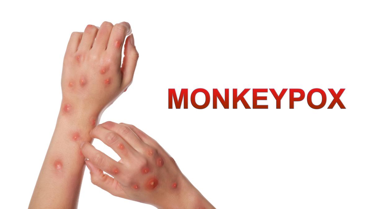mpox_58314100