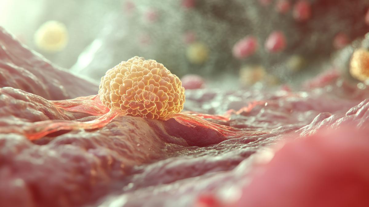 cancerul-bronhopulmonar--progrese-_66002700