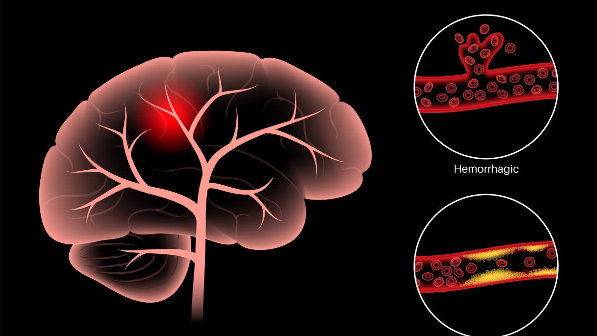 tratamentul-pentru-avc-ischemic--dr--cristian-pandrea-dizolva-cheagul-de-sange_10323300