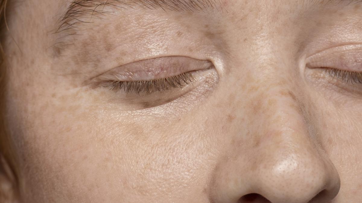 care-este-diferenta-dintre-petele-de-varsta-si-petele-solare-acestea-se-transforma-in-cancer-de-piele_70402700