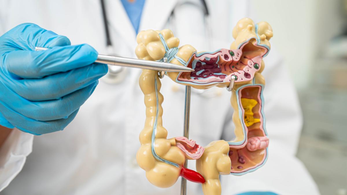 legatura-dintre-bacteriile-orale-si-riscul-de-cancer-colorectal-in-functie-de-localizare_59238100