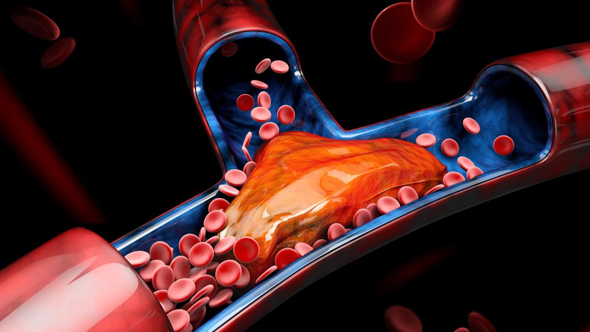 patru-schimbari-care-reduc-colesterolul-mai-eficient-decat-statinele--potrivit-unui-cardiolog_57064400
