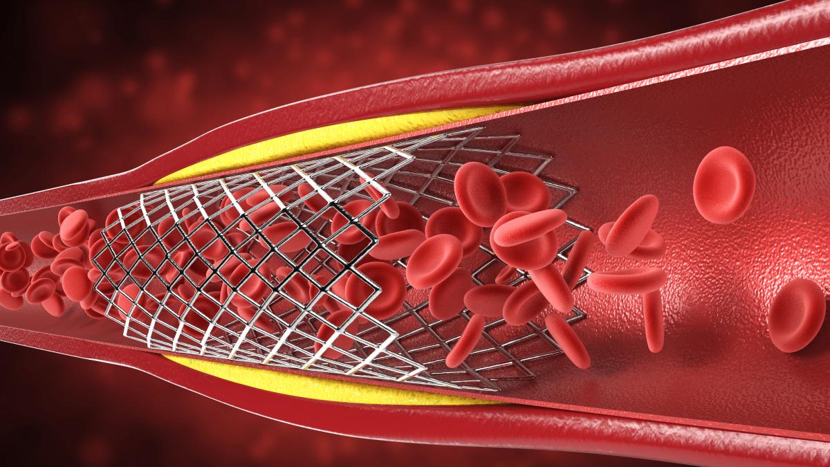 colesterolul-ridicat-si-riscurile-bolii-arteriale-periferice--semnele-care-nu-trebuie-ignorate_94923500