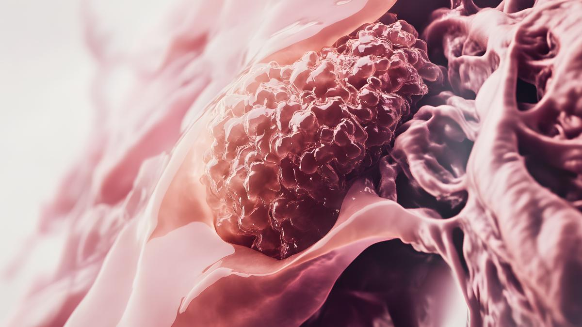 semnele-timpurii-ale-melanomului--nu-doar-forma-alunitei-conteaza_14396500