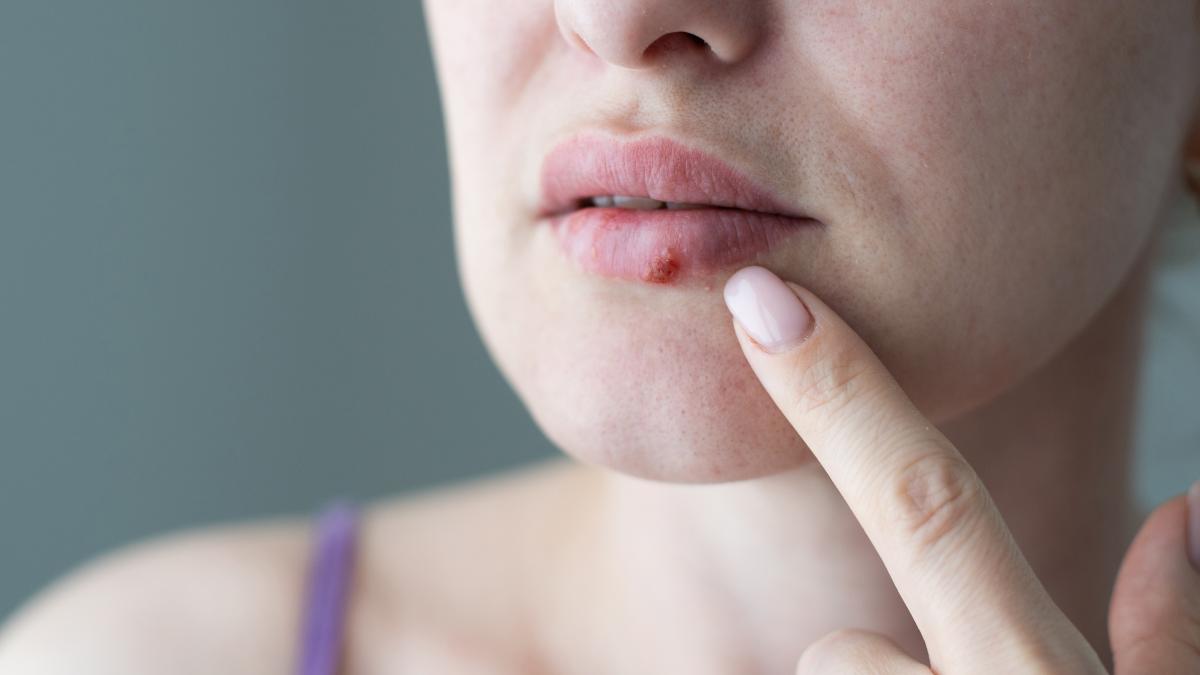 herpes-alzheimer_63533700