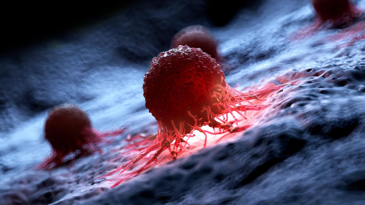 cancerul-tacut-care-scapa-la-investigatia-medicala--apare-in-alta-zona_68285800