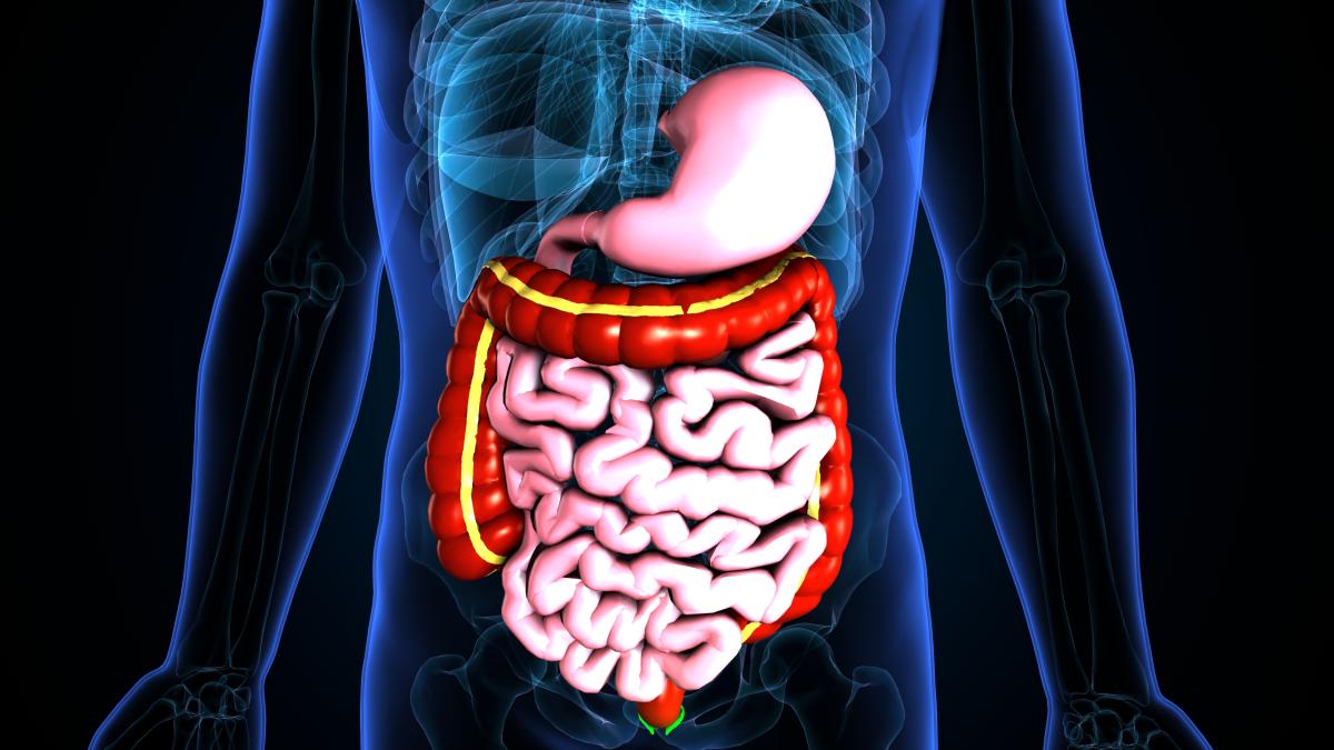 cancer colon constipatie