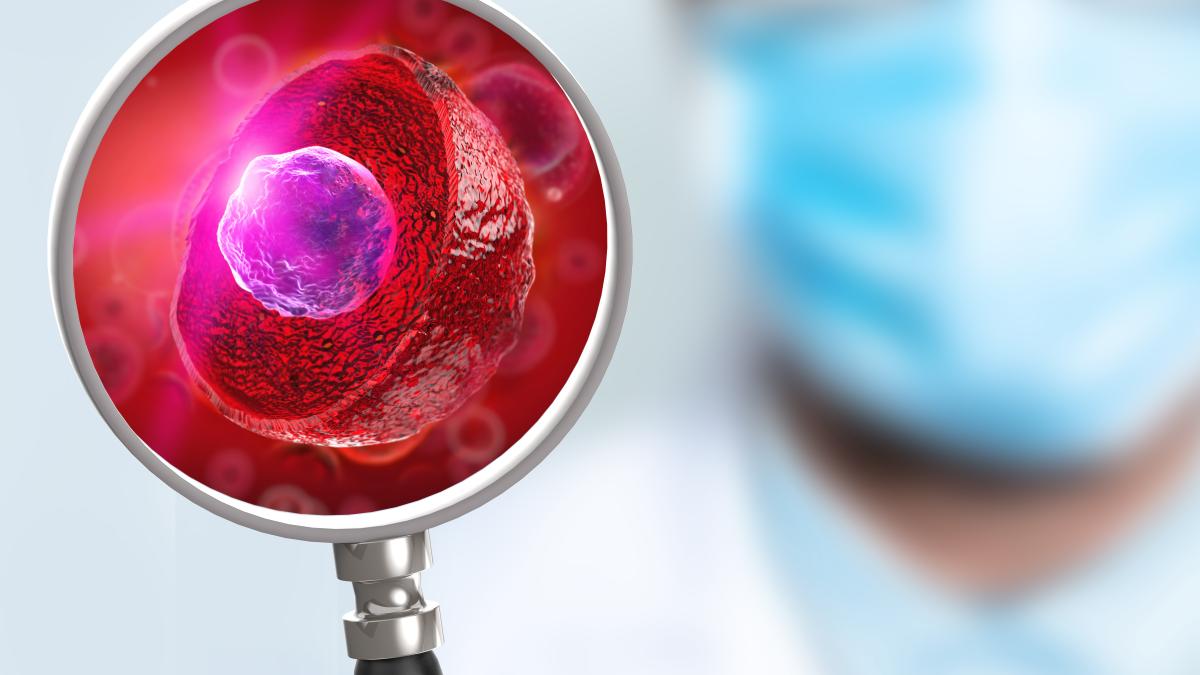 biopsie cancer prostata