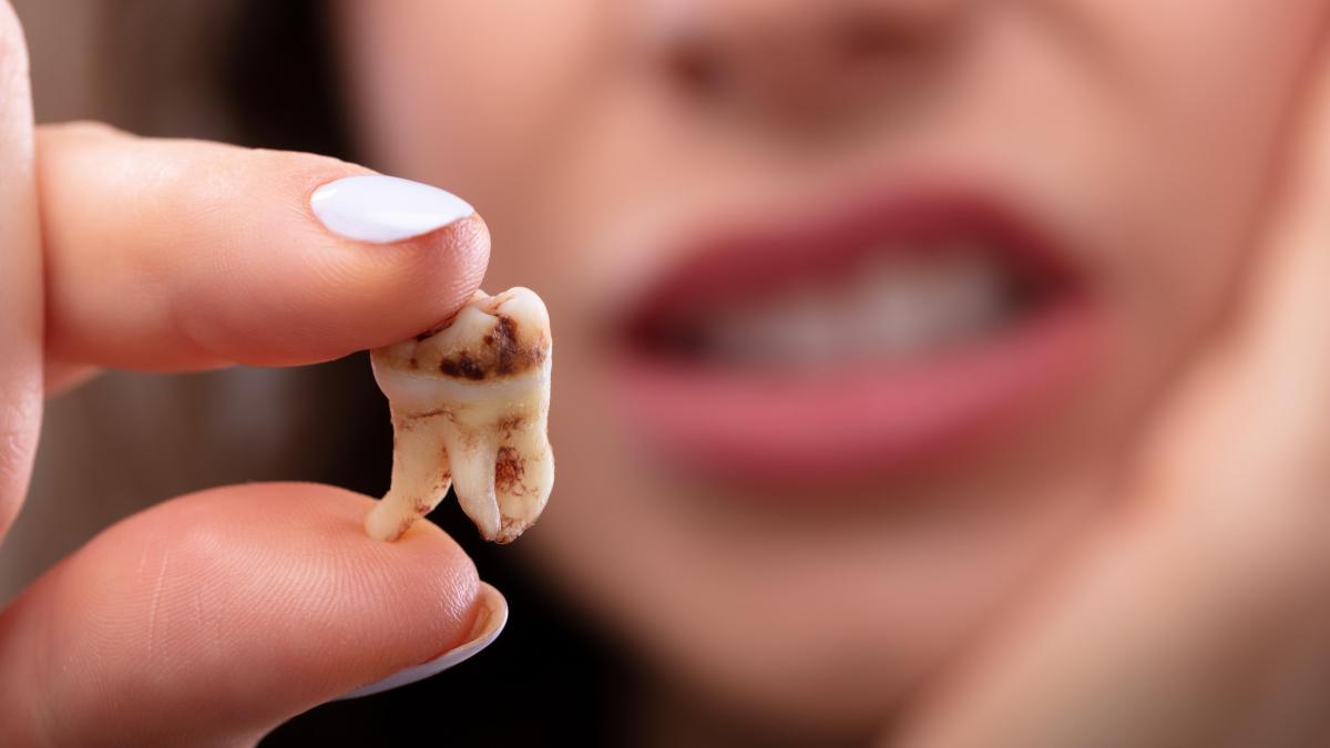carii dentare