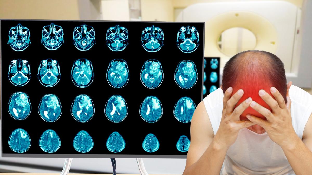 Leziunile cerebrale cresc riscul de glioblastom. Ce simptome să urmărești