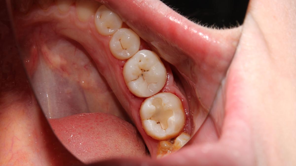alimente cari dentare