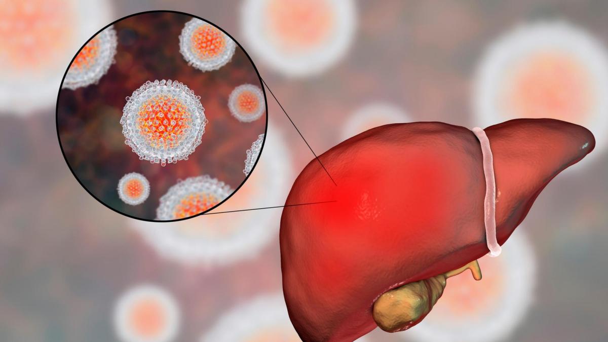 hepatita A
