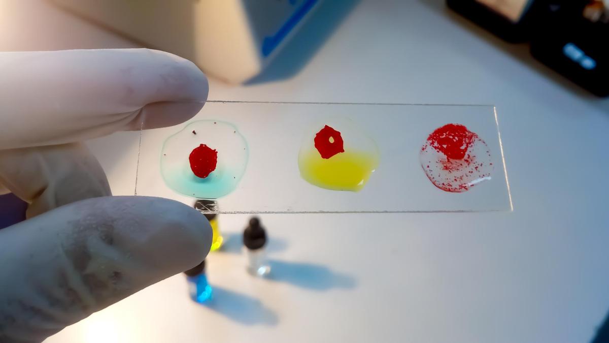 Teste hepatice ASL, ALT, GGT diferențe și ce indică fiecare