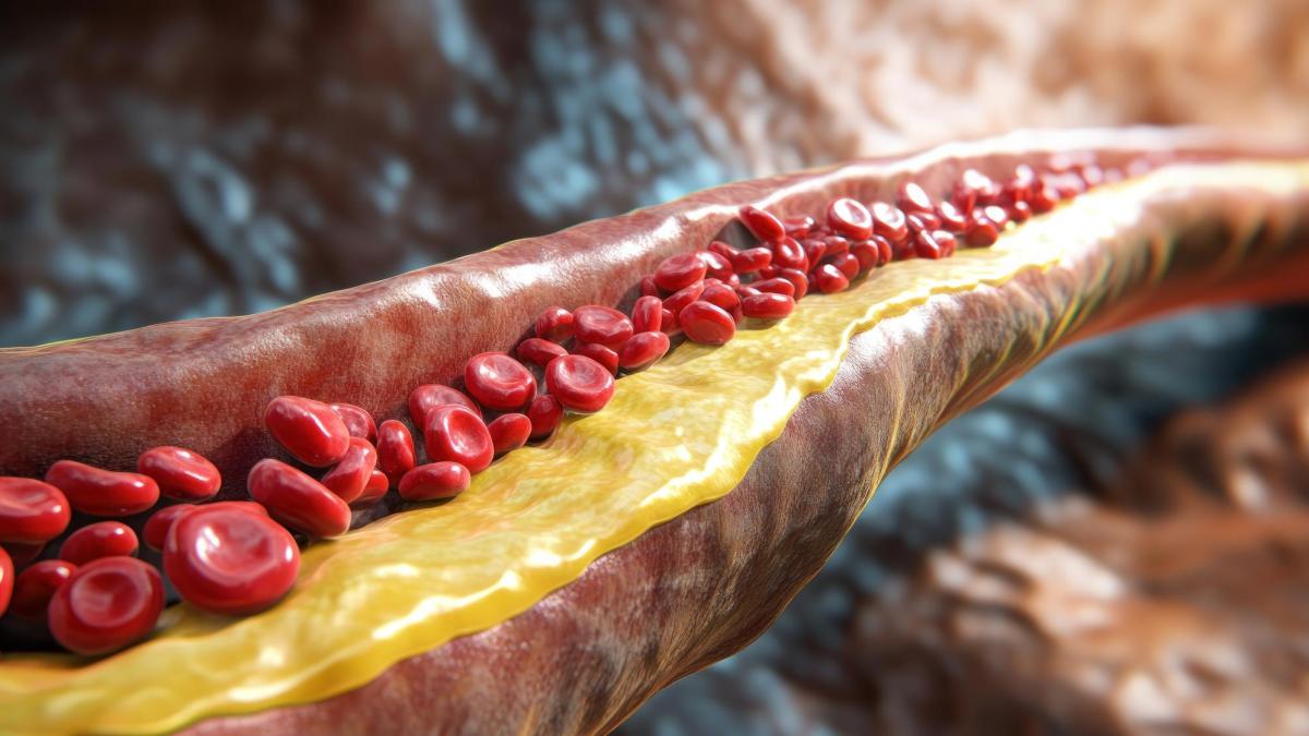 Terapia care reduce colesterolul cu aproape 50%