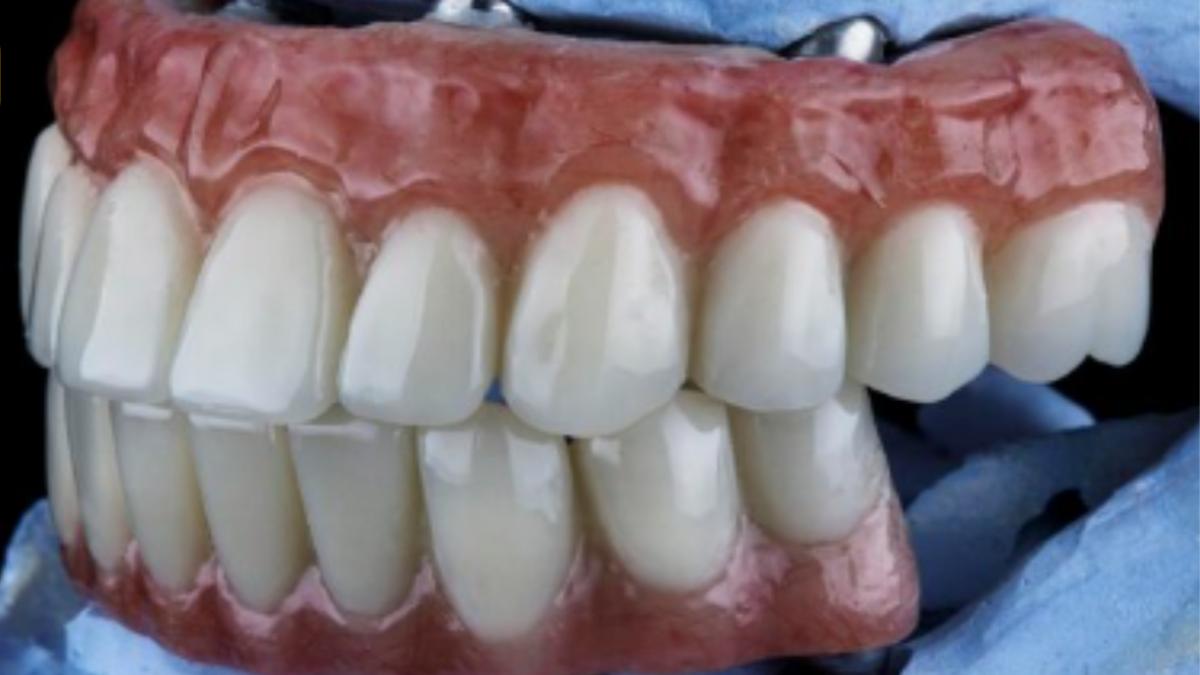 proteza-dentara-fixa-pret-clinica-stomatologica-expert-implant-bucuresti