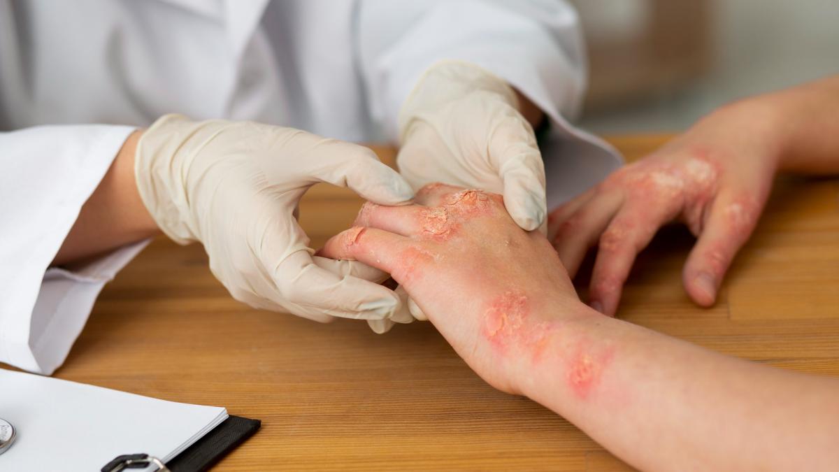 Care e diferența dintre dermatită și eczemă