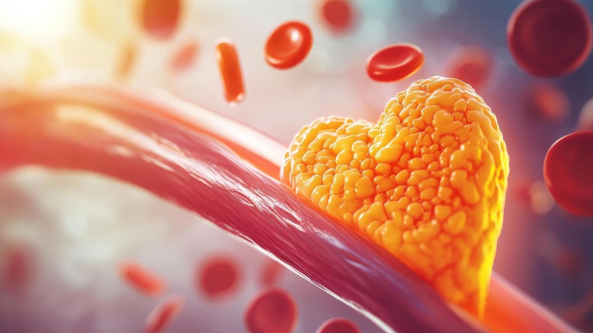 Tratamentul care scade colesterolul cu 50%. Dr. Monica Trofin Bănescu Se administrază o dată pe lună