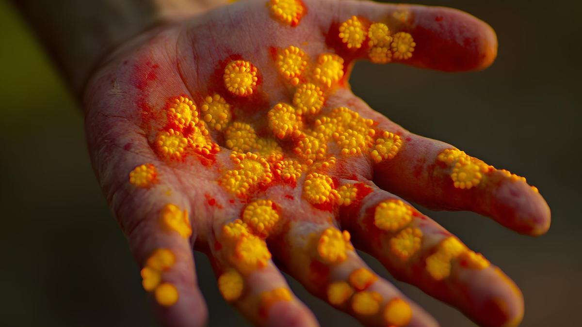 Al doilea caz de lepră confirmat la Cluj. Alte două persoane, sub investigație