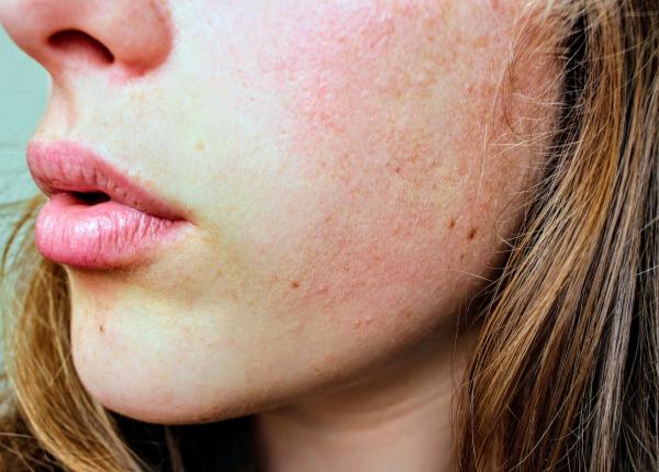 negii  metoda sigura de inlaturare a lor