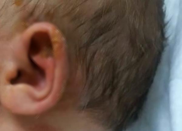 bebelu infectat cu stafilococ auriu in spitalul din baia mare