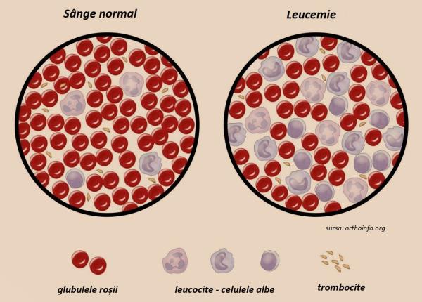 leucemia cauzele simptomele i tratamentul ei