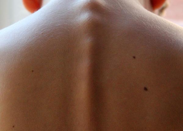 scolioza cauza nebanuita deficitul unui mineral esen ial