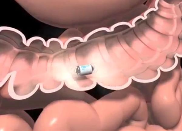 capsula endoscopica explorarea moderna a tubului digestiv capsula endoscopica explorarea moderna a tubului digestiv